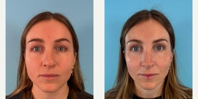 Septoplasty before and after photo