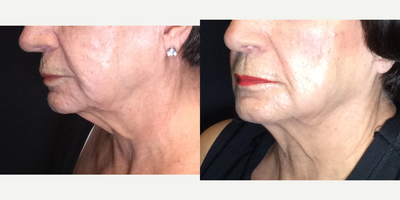 Ultherapy before and after photo