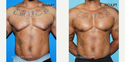 Laser Liposuction before and after photo