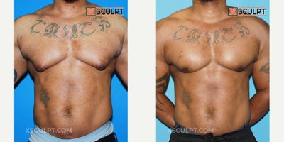 Laser Liposuction before and after photo