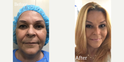 Facial before and after photo