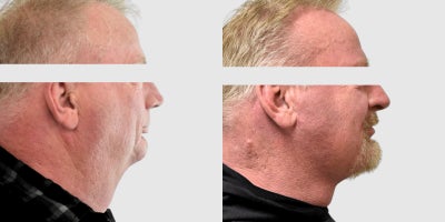 Liposuction before and after photo