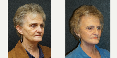 Mini Facelift before and after photo