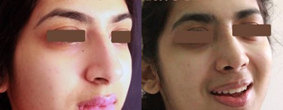 Rhinoplasty before and after photo