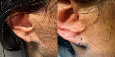 Ear Surgery before and after photo