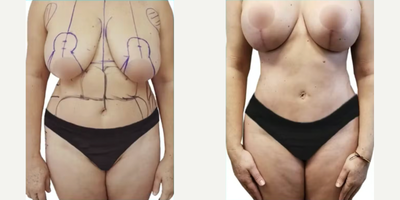 Breast Lift before and after photo