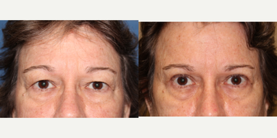 Eyelid Surgery before and after photo