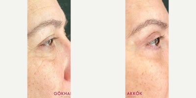 Eyelid Surgery before and after photo