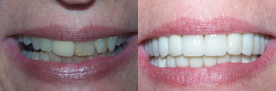 Full Mouth Reconstruction before and after photo