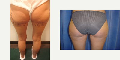 Liposuction before and after photo