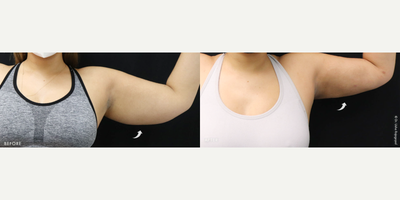 Liposuction before and after photo