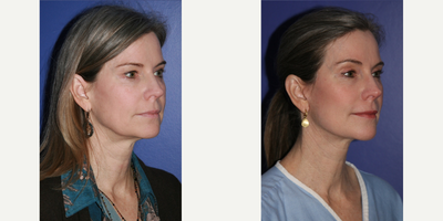 Neck Lift before and after photo