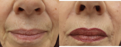 Restylane Defyne before and after photo