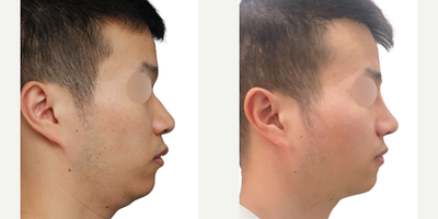 Rhinoplasty before and after photo