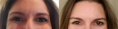 Botox before and after photo
