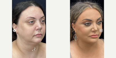 Buccal Fat Removal before and after photo
