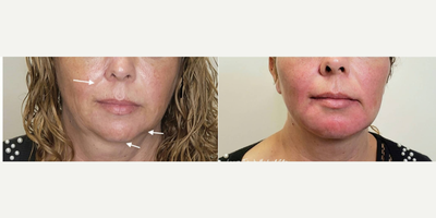 Chin Filler before and after photo