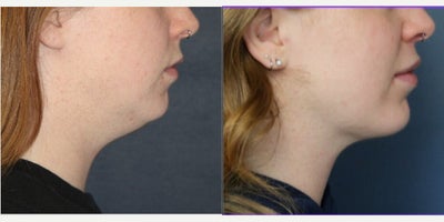 Chin Liposuction before and after photo