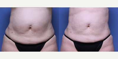 CoolSculpting before and after photo