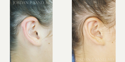 Ear Surgery before and after photo