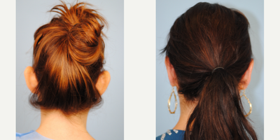 Ear Surgery before and after photo