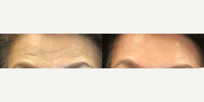 Jeuveau before and after photo