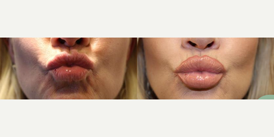 Lip Fillers before and after photo
