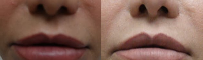 Lip Lift before and after photo