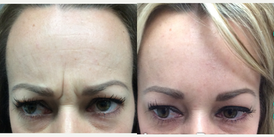 Botox before and after photo