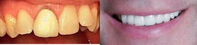 Dental Crown before and after photo