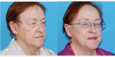 Eyelid Surgery before and after photo