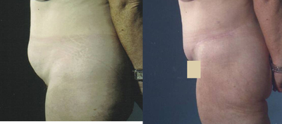 Body Lift before and after photo