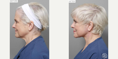 Facelift before and after photo