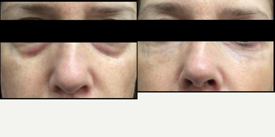 Juvederm before and after photo