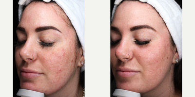 Halo Laser before and after photo