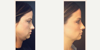 Kybella before and after photo