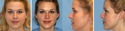 Rhinoplasty before and after photo