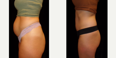 Tummy Tuck before and after photo