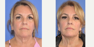 Facelift before and after photo