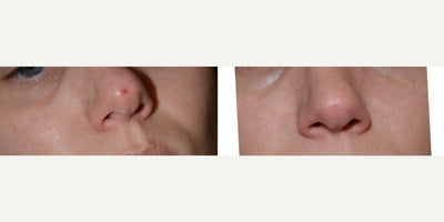 IPL before and after photo
