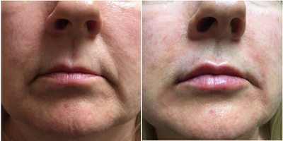 Juvederm before and after photo