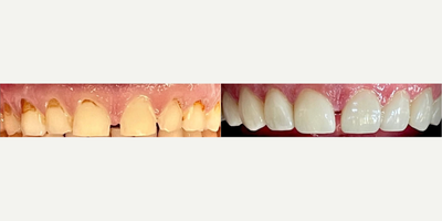Porcelain Veneers before and after photo