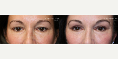 Brow Lift before and after photo