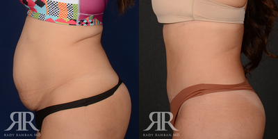 Diastasis Recti Repair before and after photo