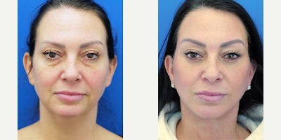 Eyelid Surgery before and after photo