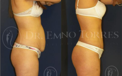 Tummy Tuck before and after photo