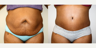 Tummy Tuck before and after photo