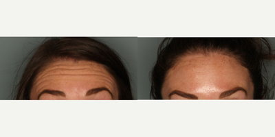 Botox before and after photo