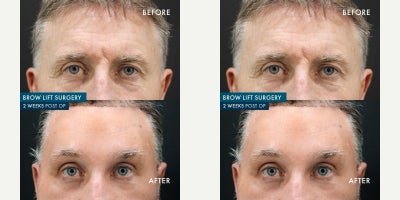 Brow Lift before and after photo