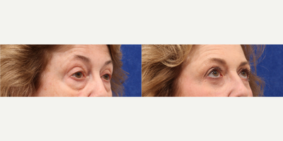 Eyelid Surgery before and after photo